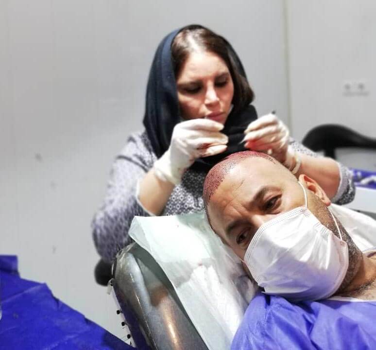 کاشت گرافت های برداشت شده در کلینیک کاشت مو شیوا کیانی در اهواز کاشت گرافت های برداشت شده در کلینیک کاشت مو شیوا کیانی در اهواز